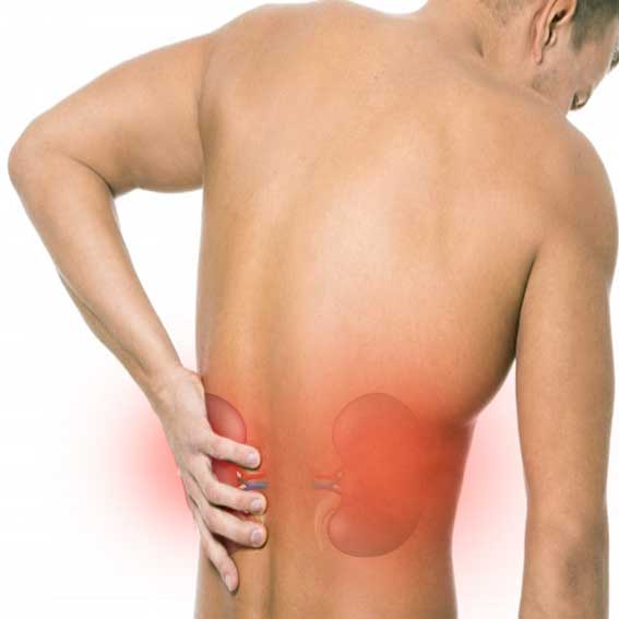 stone in kidney pain illustration