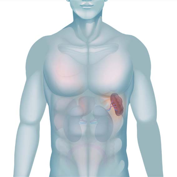 Unani treatment for spleen enlargement