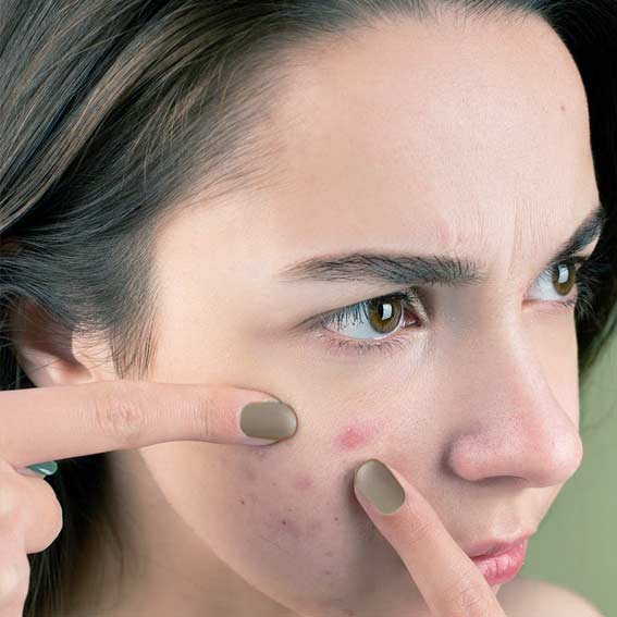 how to remove pimples naturally and permanently with Unani treatment